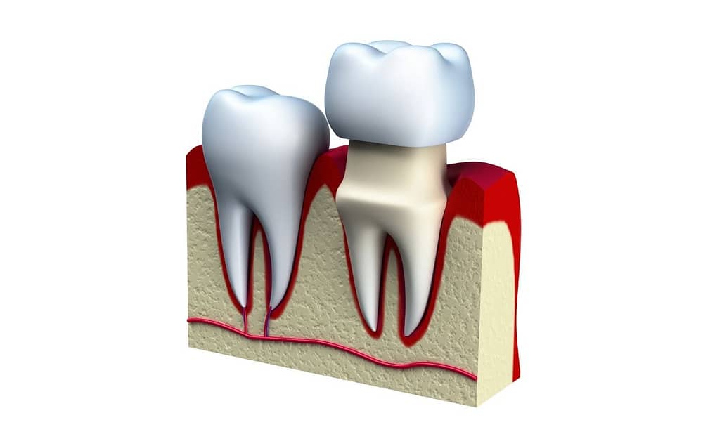 dental-crown-dental-implants-101