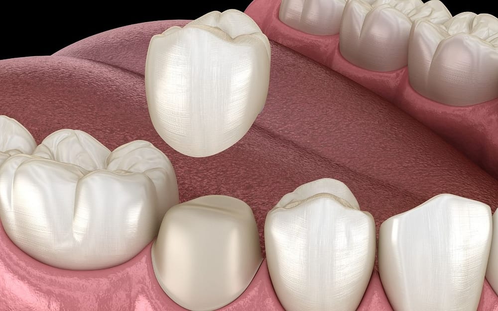 difference-between-crown-and-implants-Bradford-Dentist