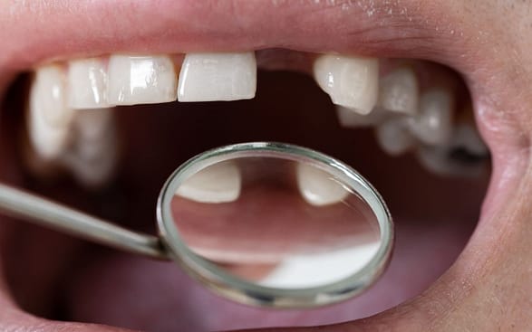 reasons-you-may-need-dental-implants