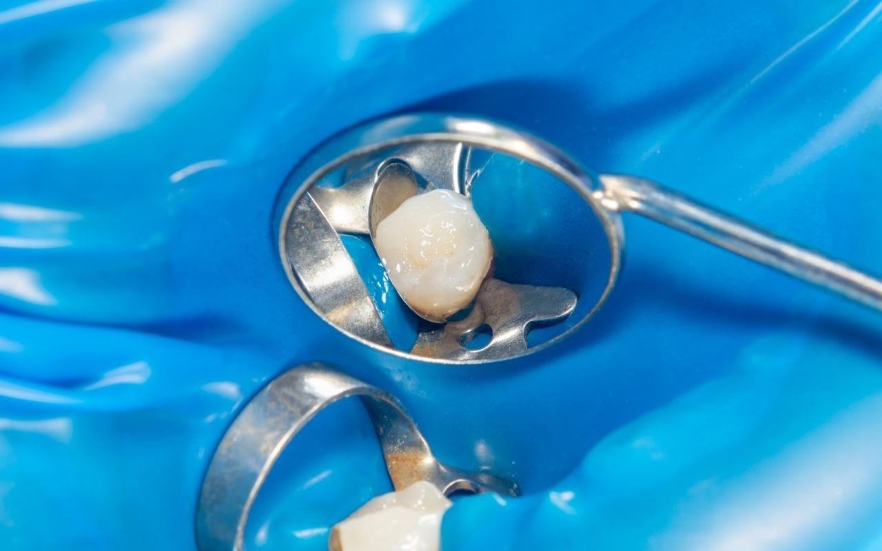 composite-white-fillings-modern-dentistry