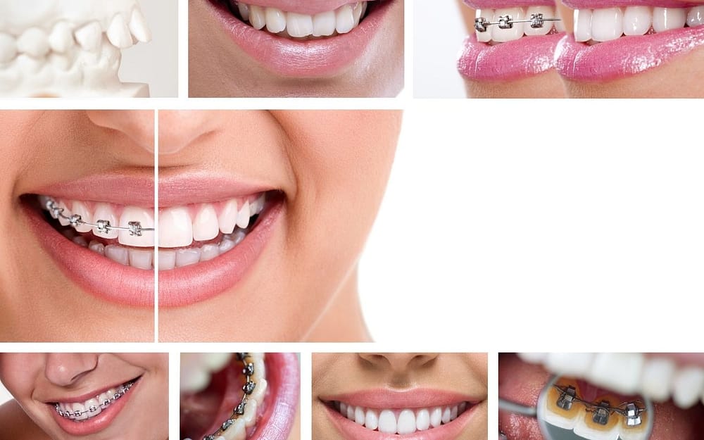 signs-you-should-consider-adult-braces-Bradford-Dentist