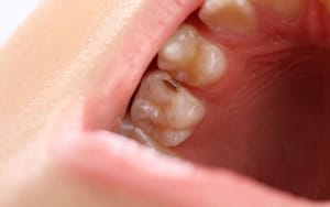 What are Dental Sealants - Cavities Chronic Disease - Bradford Family Dentist
