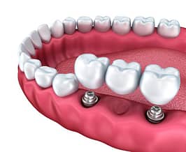 Bradford Dental Implants Bridge Diagram