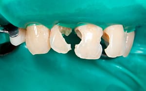 Broken Teeth - 7 Reasons to Fix Crooked Teeth - Bradford Family Dentistry