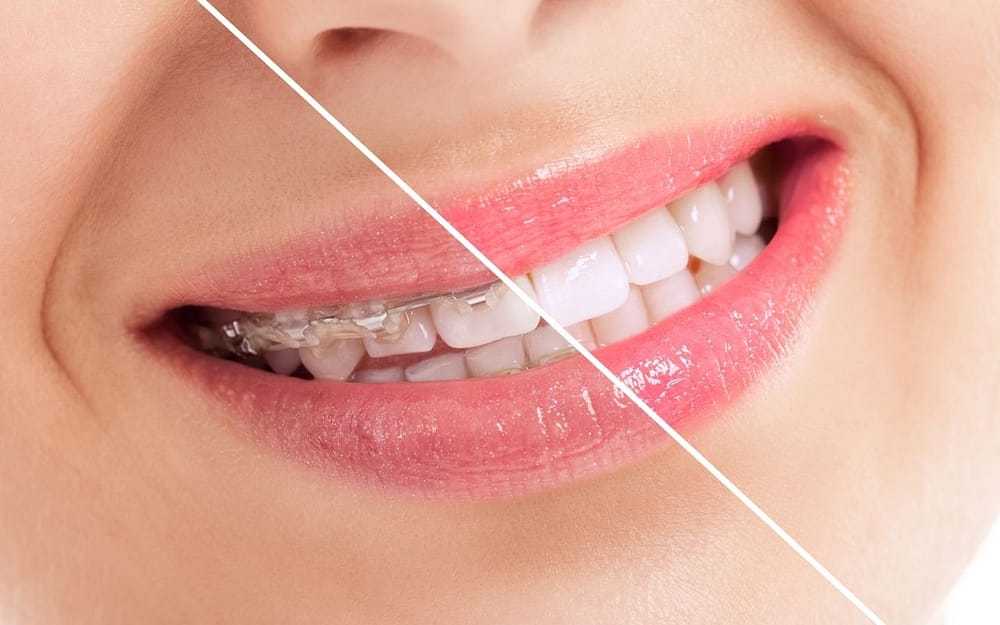 how-long-does-orthodontic-treatment-last-Bradford-Dentist