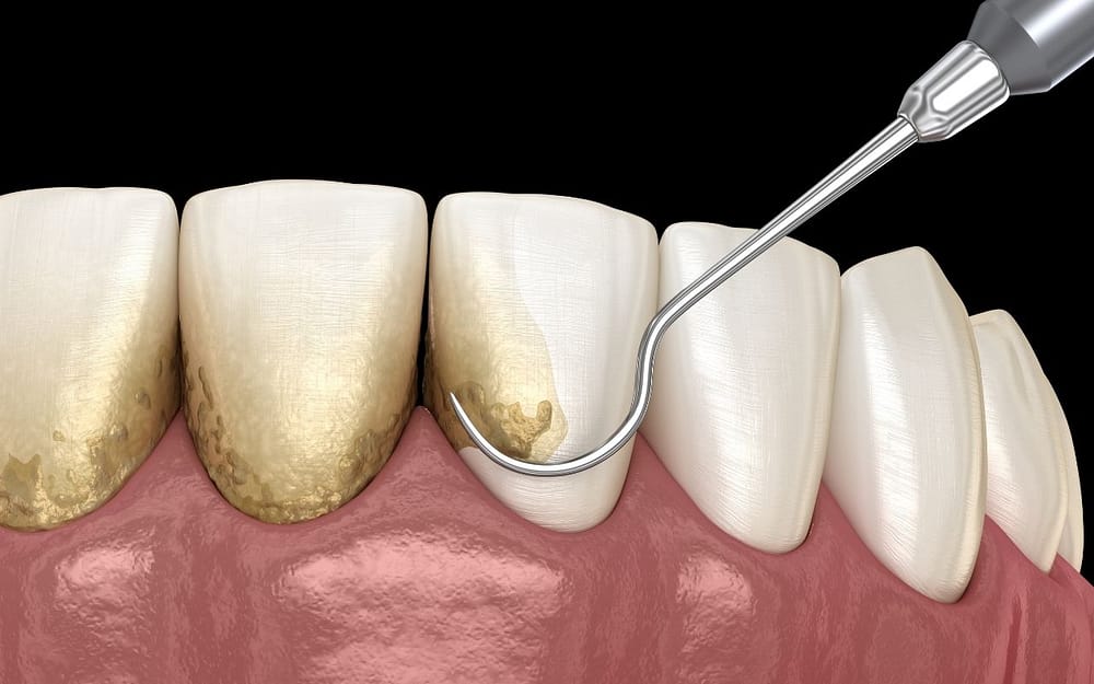 can-gingivitis-be-reversed-Bradford-Family-Dentistry