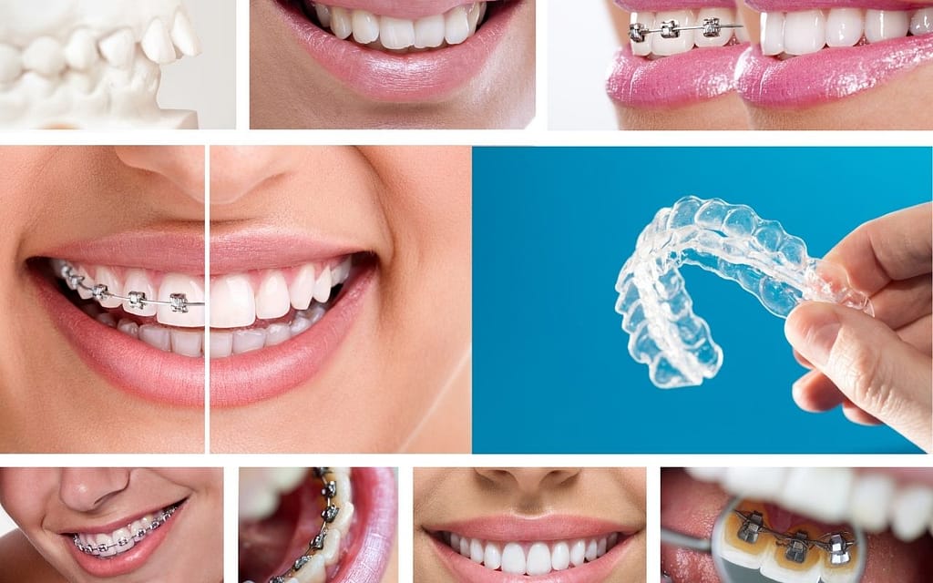how much do braces cost in Bradford - cost of braces in Bradford
