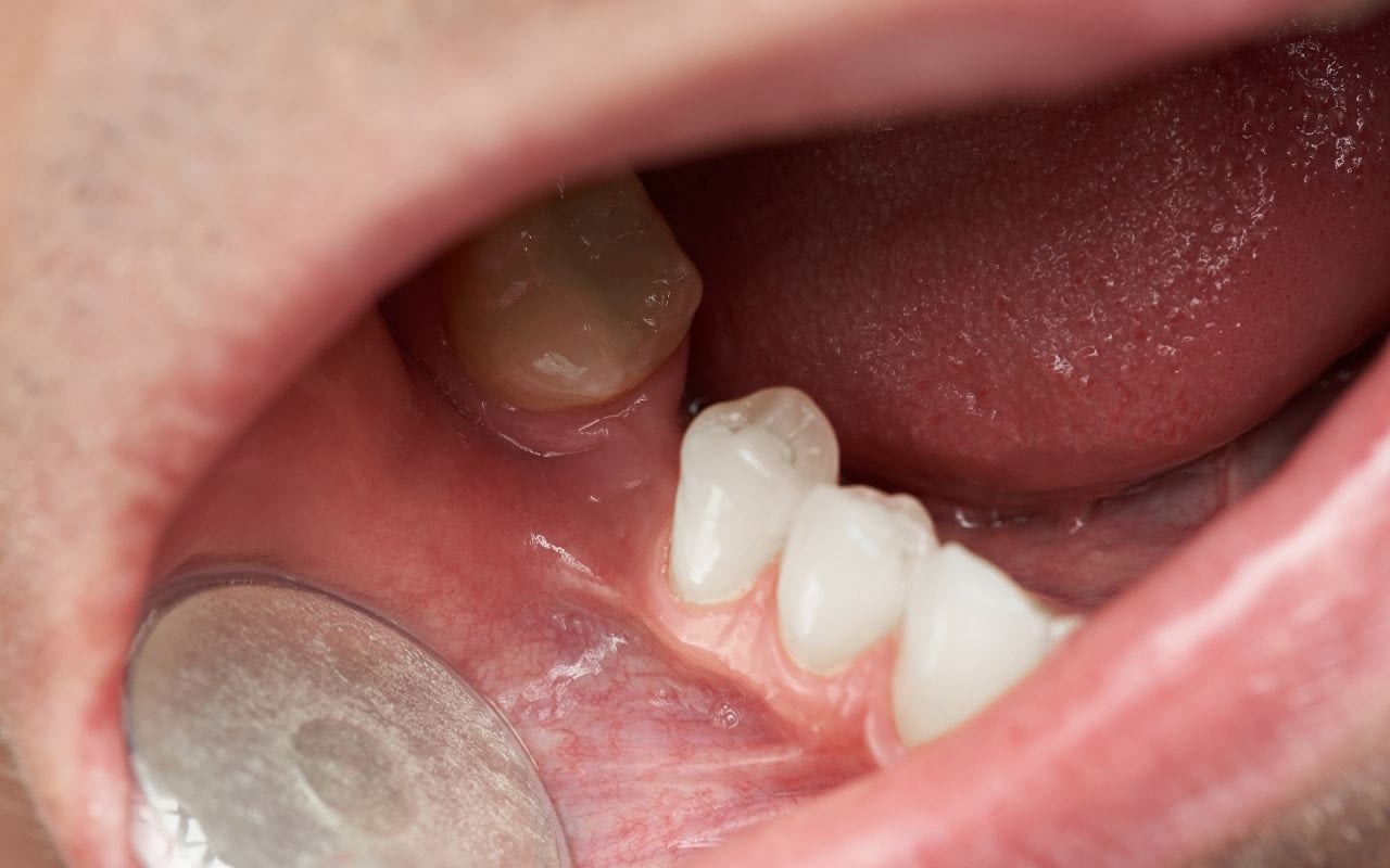 gaps-between-teeth-cause-food-traps-Bradford-Dentist