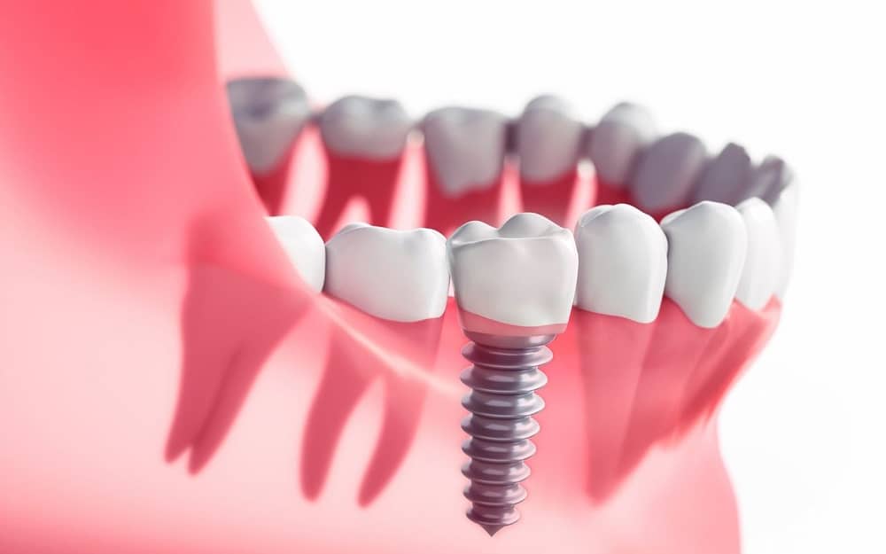 what-are-dental-implants-dental-implants-101