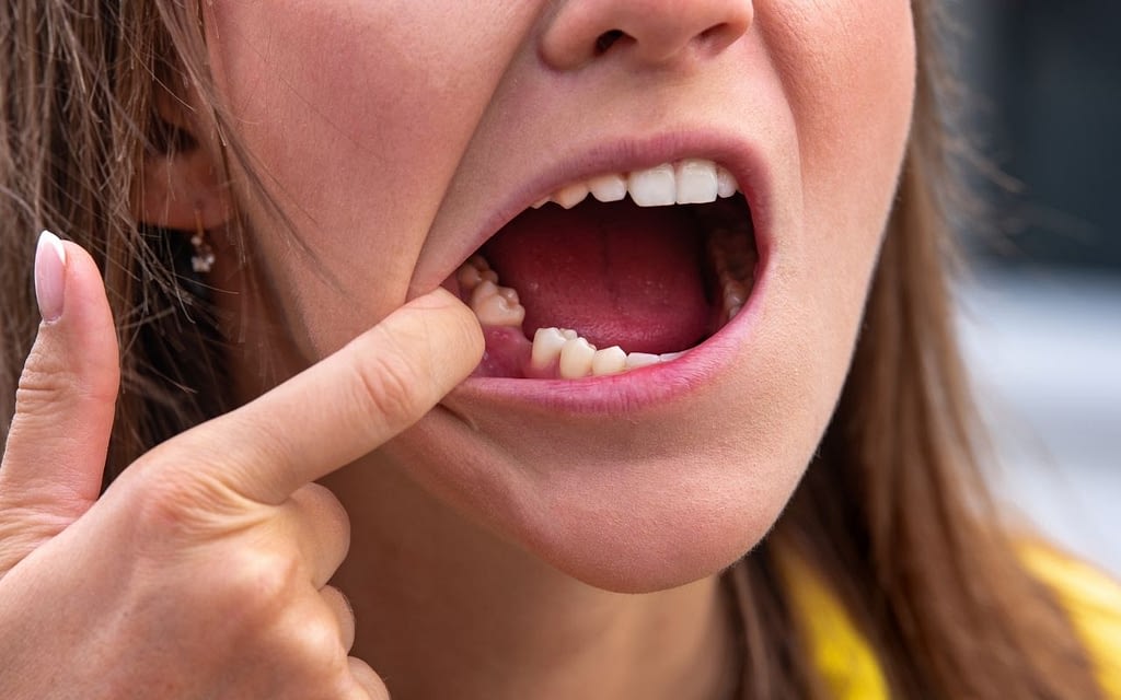 dry-socket-can-be-serious-after-tooth-extraction-Bradford-Dentist