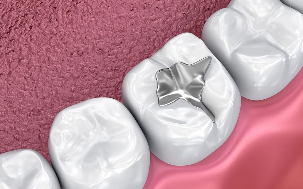 dental-amalgam-pros-and-cons-of-different-types-of-dental-fillings