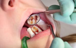 Cavities Caused by Bacteria - Cavity Treatment - Bradford Family Dentistry