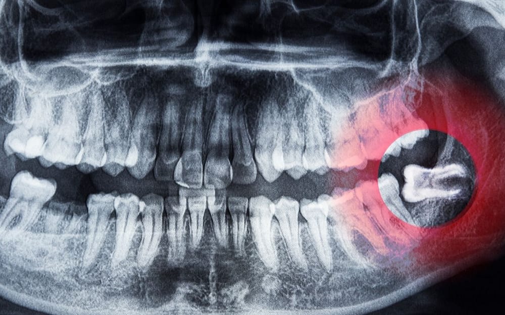 what-are-impacted-wisdom-teeth