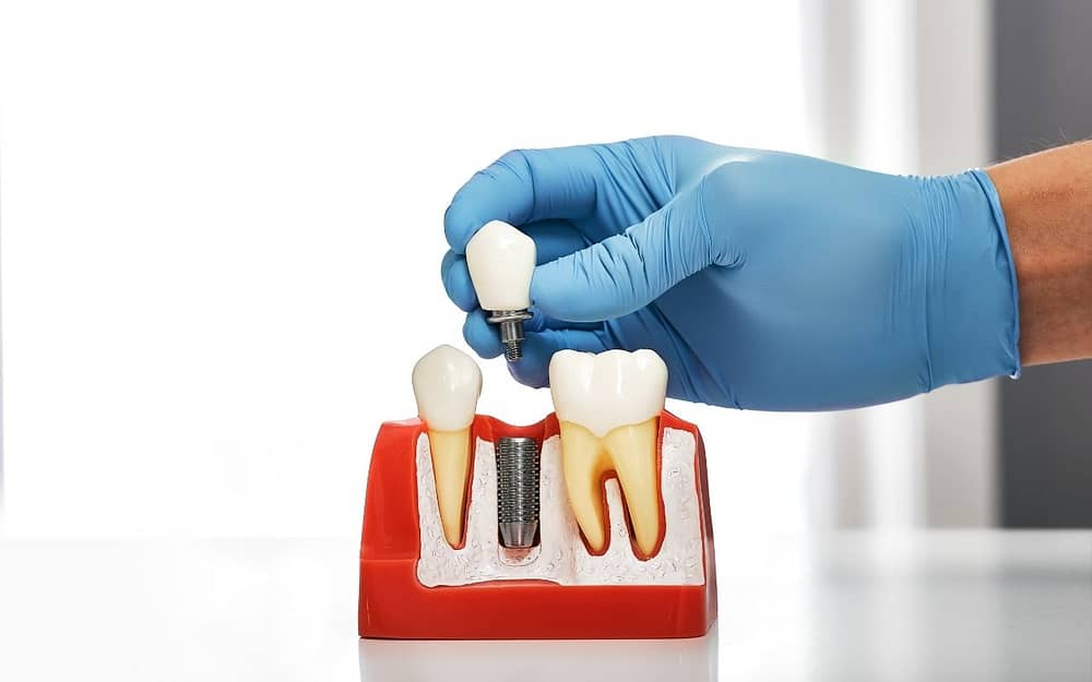how-are-dental-implants-inserted-commonly-asked-questions-about-dental-implants