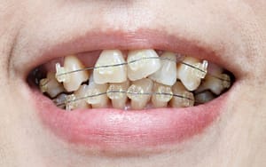 Premature Tooth Wear - 7 Reasons to Fix Crooked Teeth - Bradford Dentist