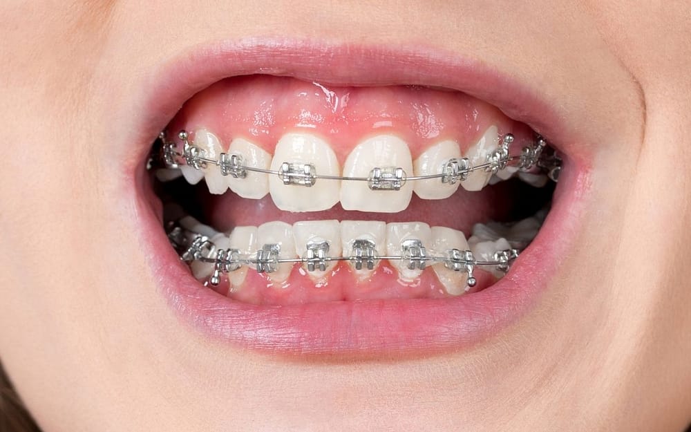 gum-massage-when-cleaning-teeth-with-braces-Bradford-Dentist