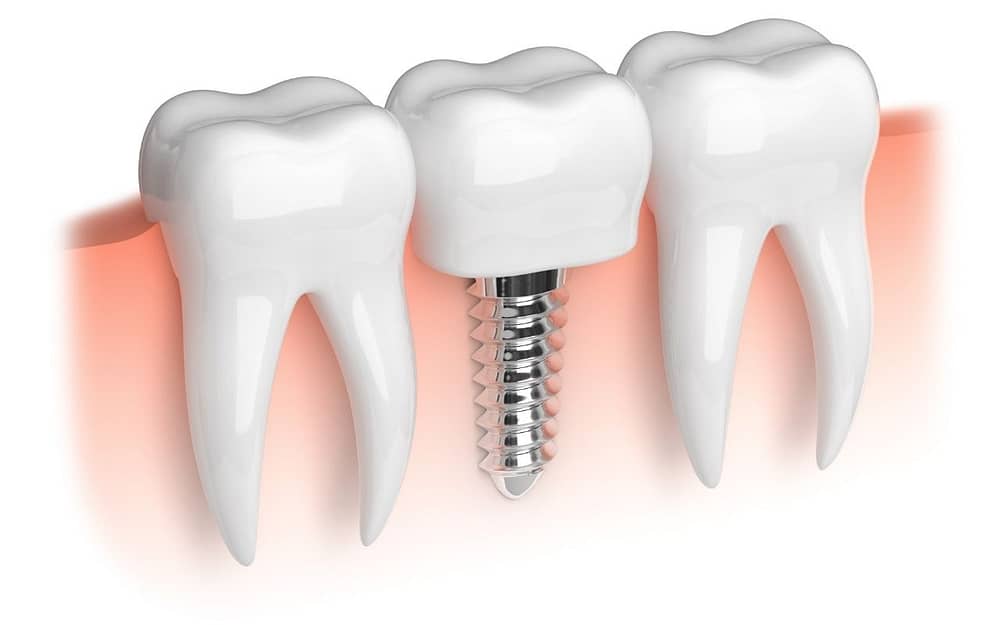 dental-implant-Bradford-Dentist