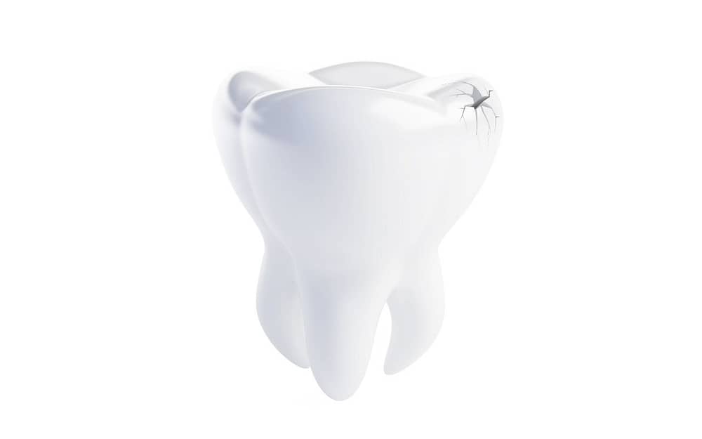 cracked-tooth-causes-tooth-pain-Bradford-Dentist