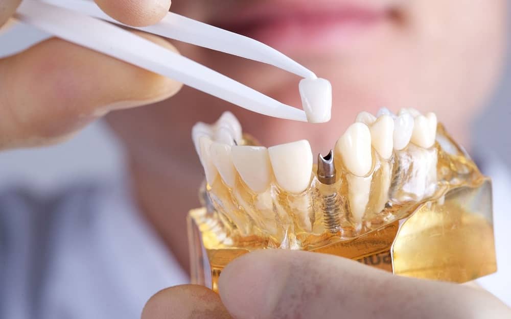 dental-implants-modern-dental-clinic