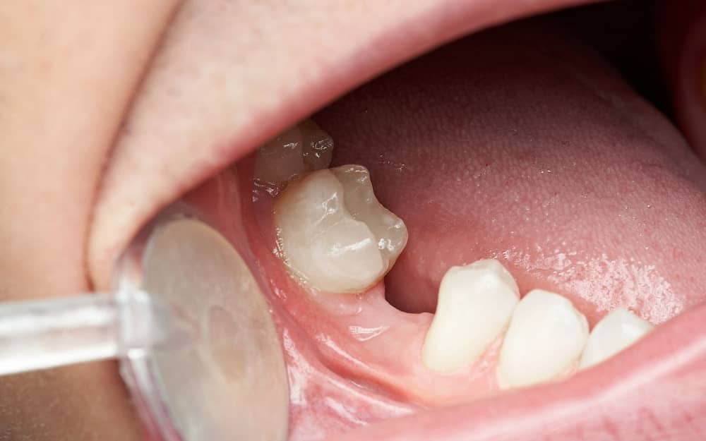 common-dental-problems-missing-tooth