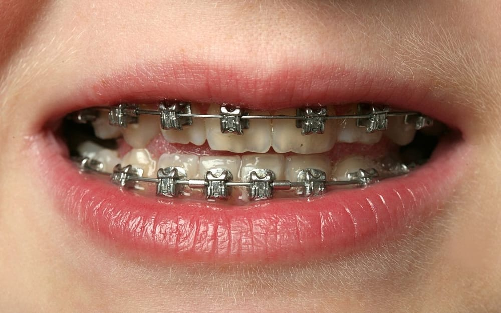 risk-factors-for-teen-gum-disease-Bradford-Dentist