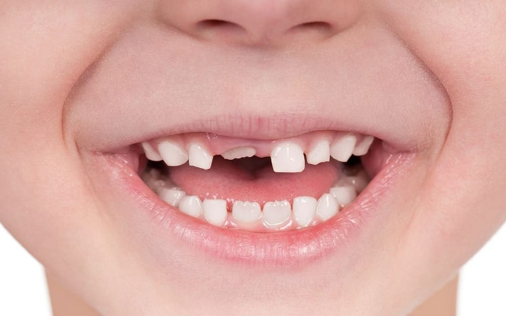 stubborn-baby-teeth-one-of-most-common-childhood-dental-problems