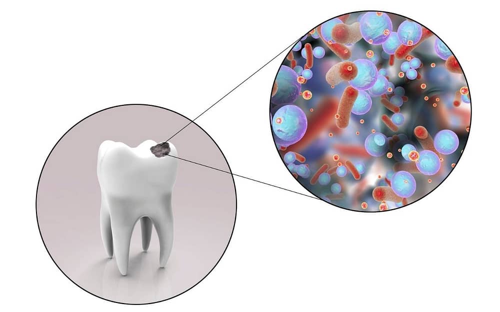 oral-microbiome-and-cavities-Bradford-Dentist