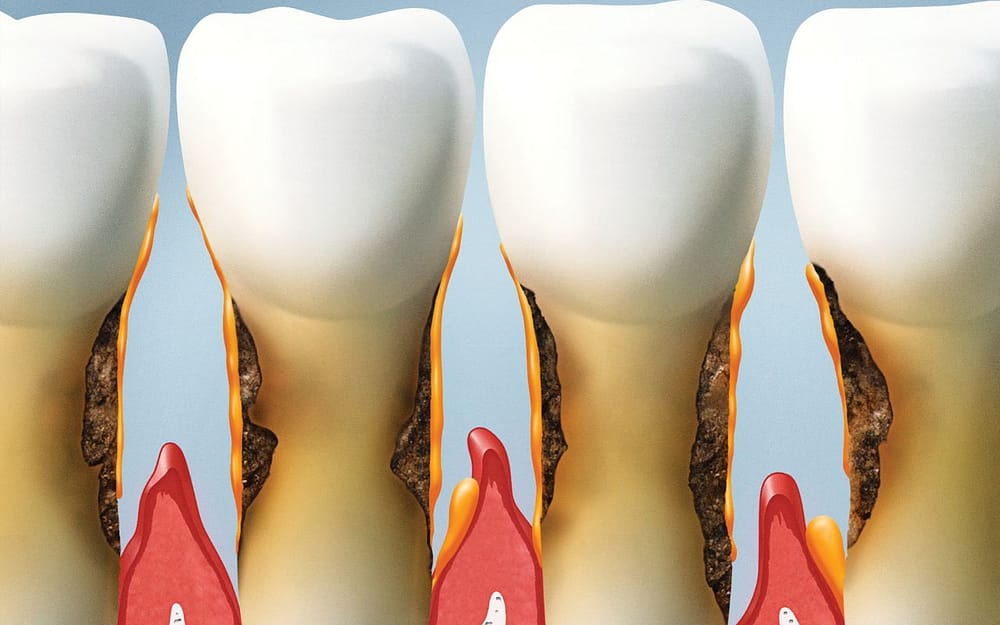 stage-5-gum-disease-advanced-periodontitis