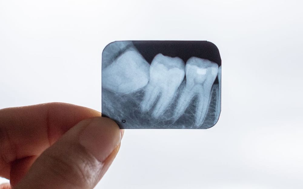 can-impacted-wisdom-teeth-be-prevented