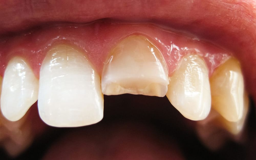 Lower-Likelihood-of-Dental-Injuries-after-braces