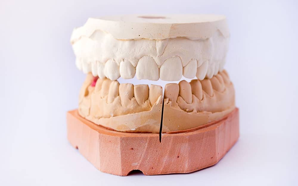 Unmatched-Dental-Midlines-braces-before