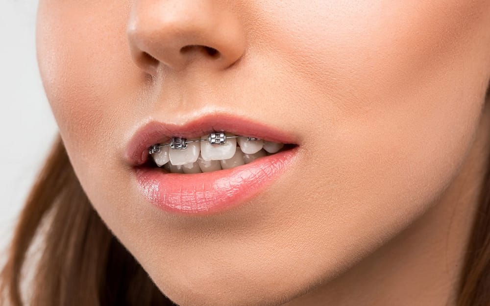 braces-before-Overbites-and-Underbites