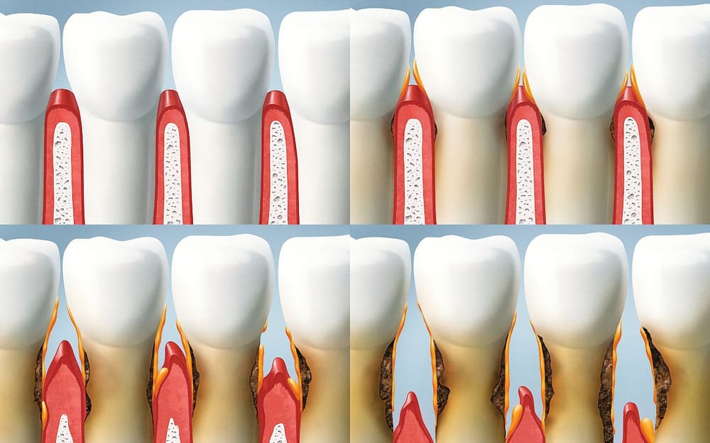 stages-of-gum-disease-how-dental-care-helps-protect-your-respiratory-system