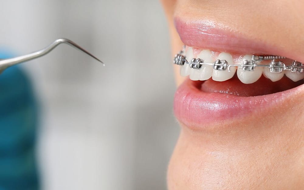 what-to-do-if-braces-brackets-are-loose