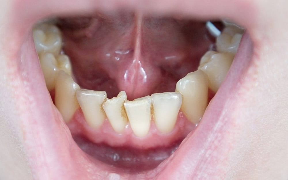 gum-issues-from-overcrowding-can-be-prevented-with-braces