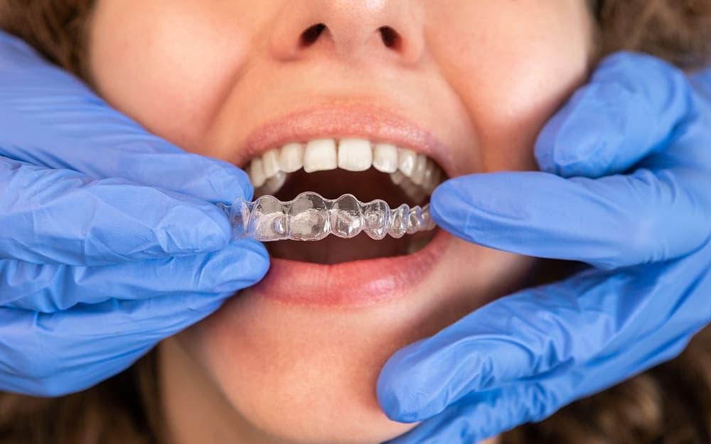 how-invisalign-helps-with-dental-issues