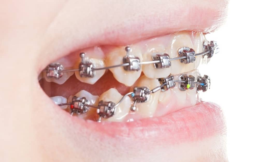 malocclusions-are-dental-problems-that-can-be-corrected-with-braces-or-invisalign