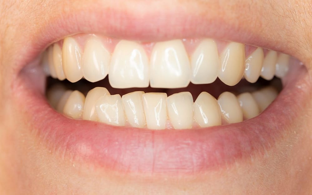 mismatched-dental-midlines-can-be-corrected-with-braces