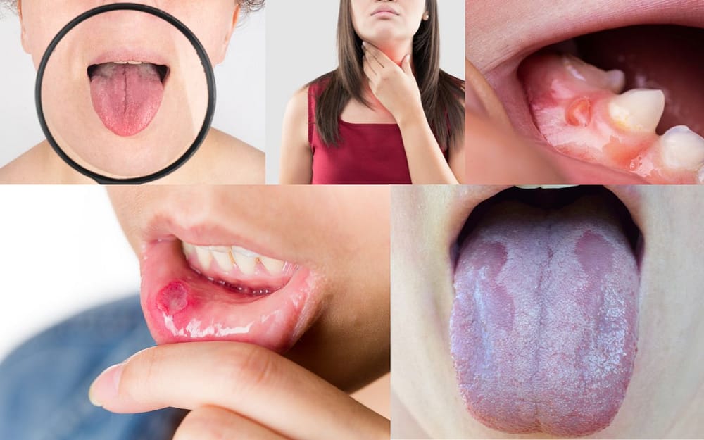 common-oral-cancer-symptoms