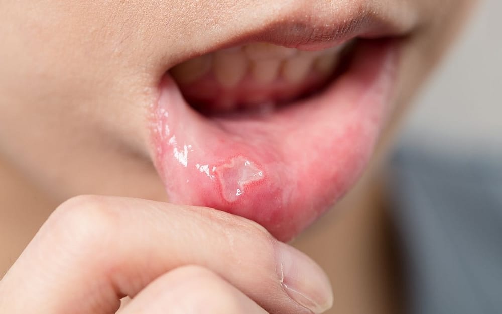common-dental-problems-mouth-sores