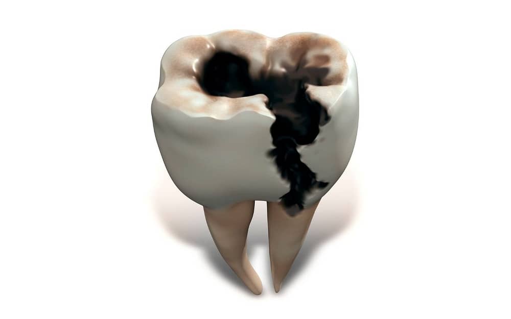 common-dental-problems-root-infection