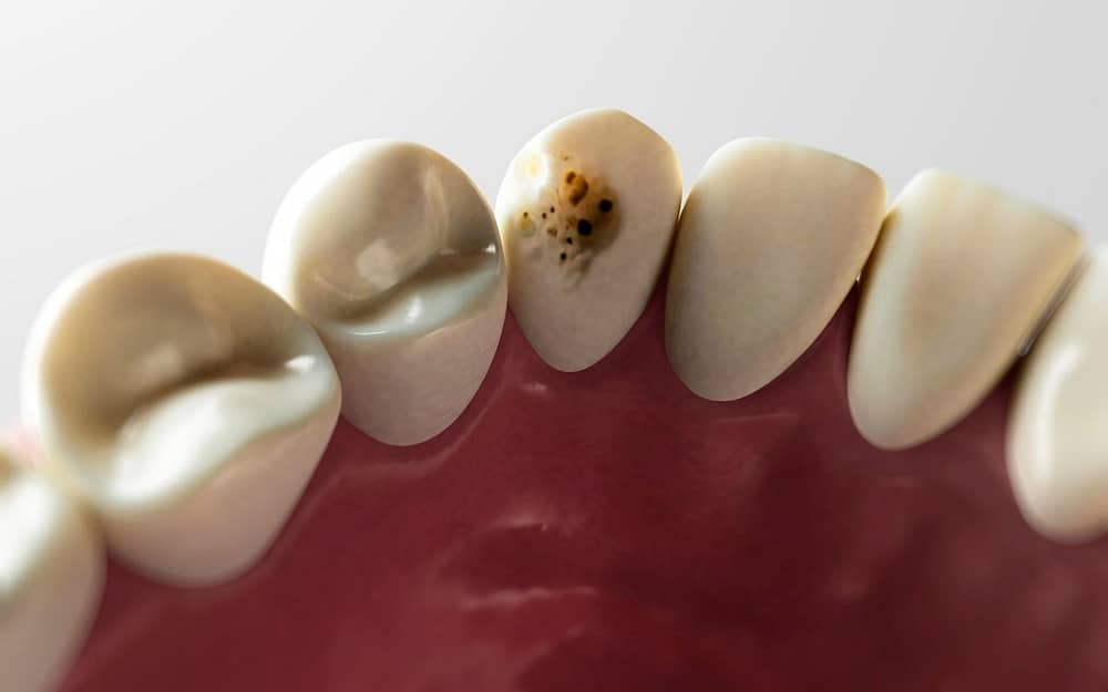 tooth-decay-one-of-the-most-common-dental-problems