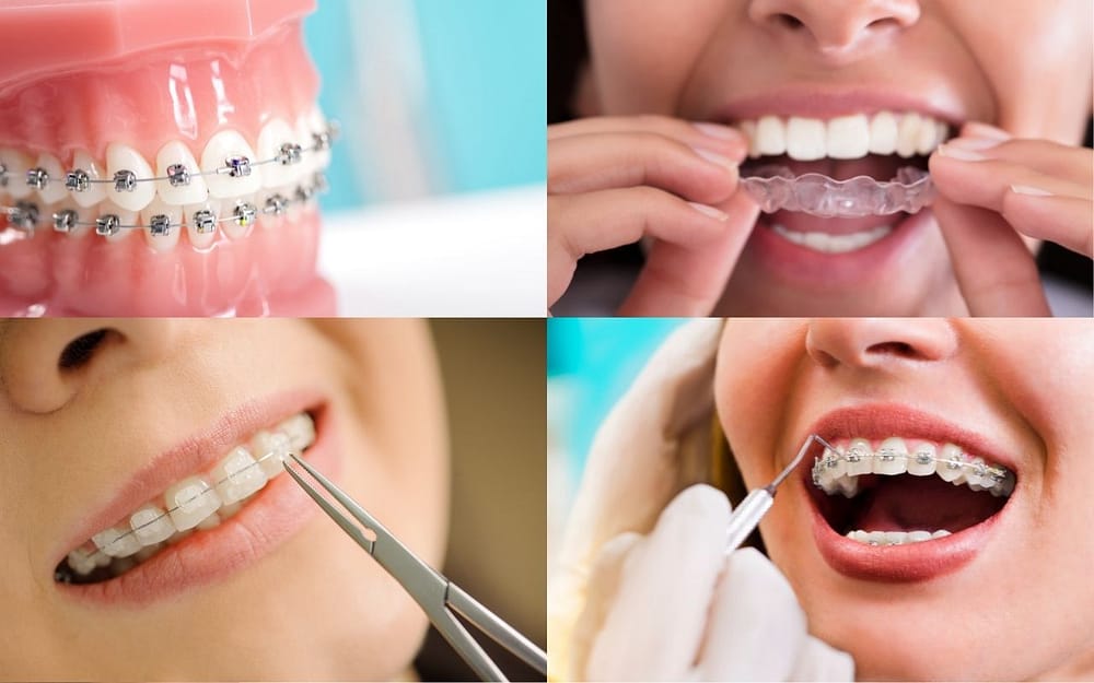 types-of-orthodontic-treatment-Bradford-Family-Dentistry