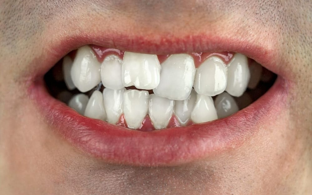 why-do-people-need-orthodontic-treatment-Bradford-Dentist