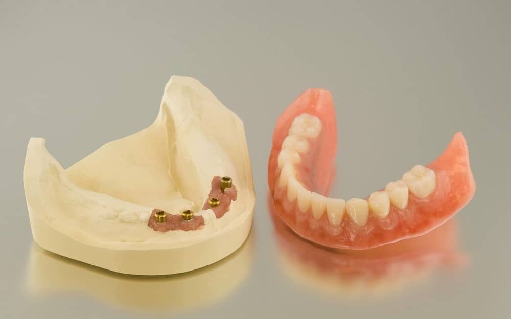 dental-implants-vs.-dentures-Bradford-Family-Dentistry