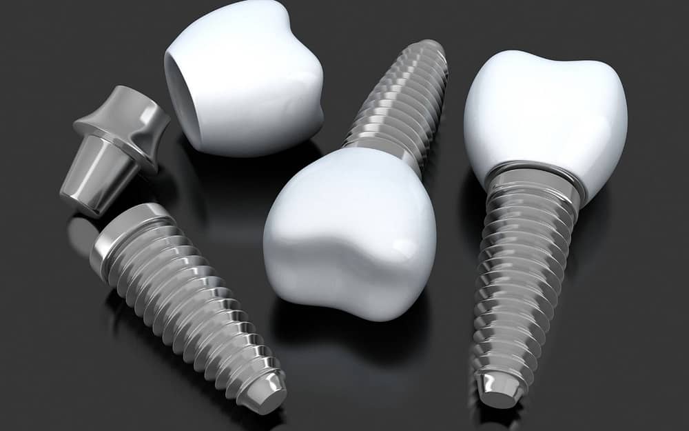 what-are-dental-implants-commonly-asked-questions-about-dental-implants