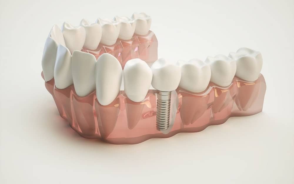 what-are-the-benefits-of-dental-implants-commonly-asked-questions
