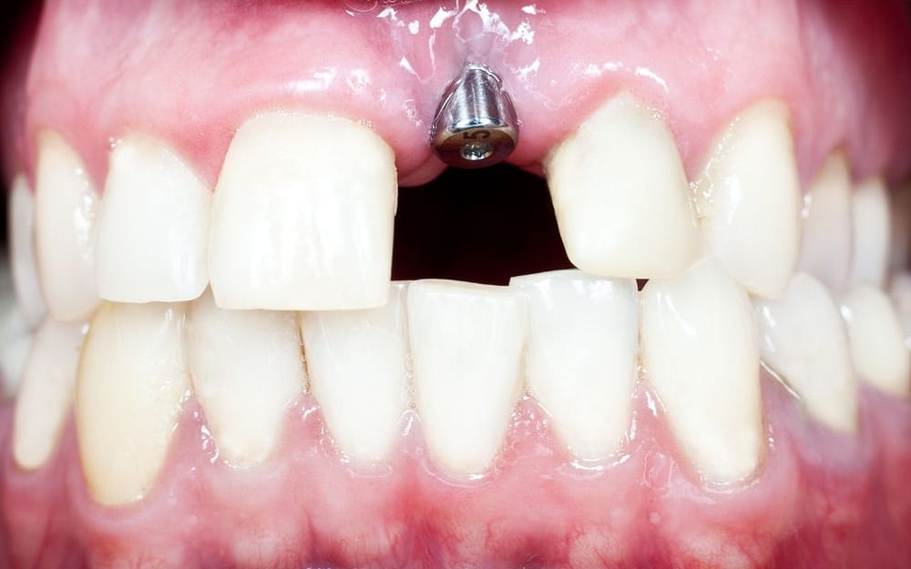 when-are-dental-implants-recommended
