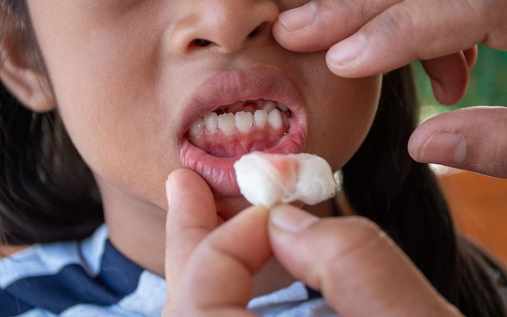 gum-disease-in-kids-common-childhood-dental-problems-Bradford-Dentist