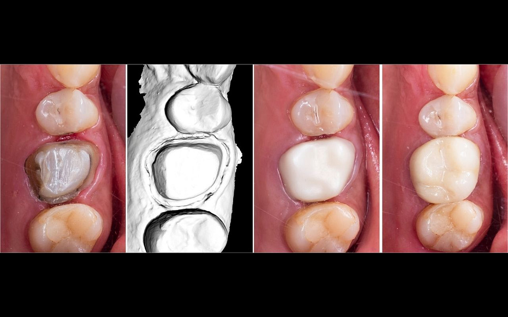 crowns-different-types-of-dental-fillings-Bradford-Dentist